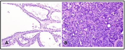 Figure 1. Tubulocystic renal cell carcinoma
