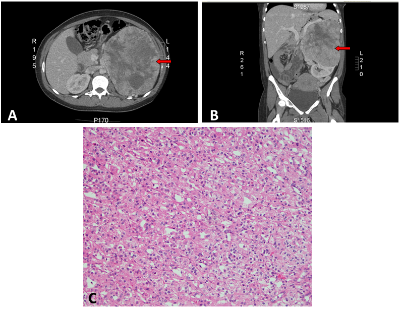 Figure 1. Computed tomography of abdomen and the histology of RCC.